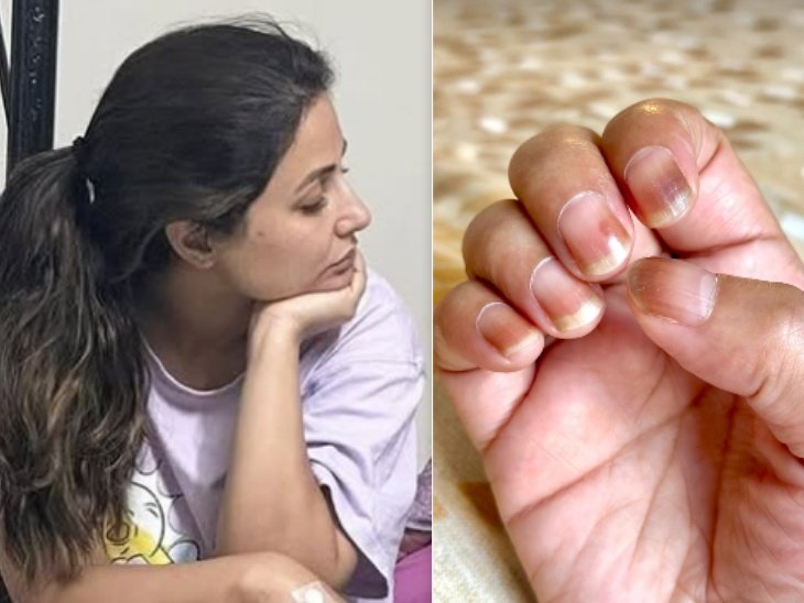 Hina Khan's Nails Got Dried Due to Chemotherapy | Hina Khan's nails dried up with chemotherapy: The actress said, this is side effect, sometimes these nails also get uprooted, there is happiness that all this is Temporary